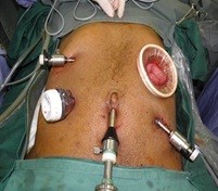 Gastric Cancer (Stomach Cancer)