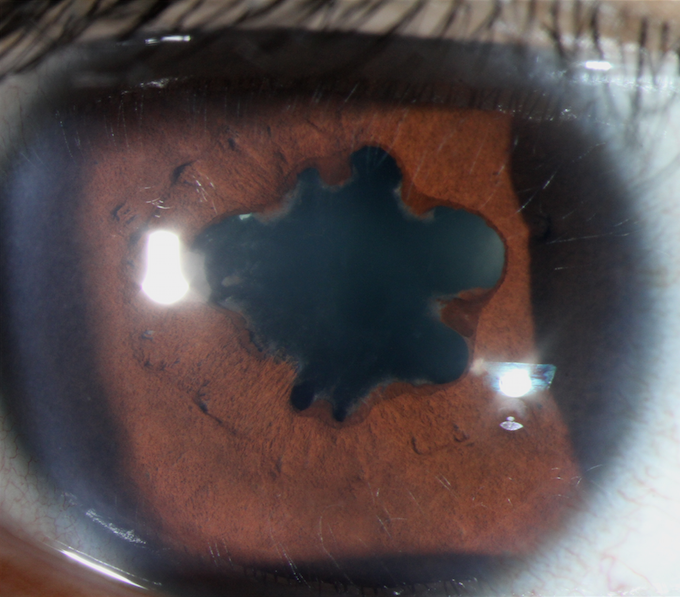 Ocular Inflammation (Uveitis)