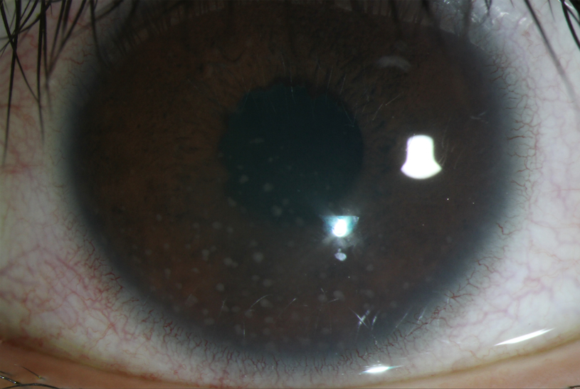 Ocular Inflammation (Uveitis)