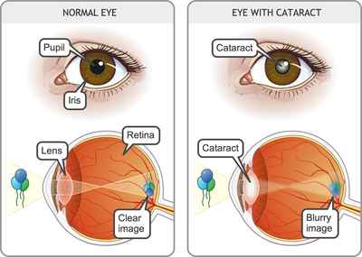 Paediatric Cataracts