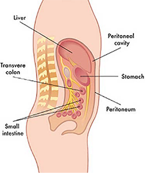 Peritoneal Metastases (Peritoneal Cancer)