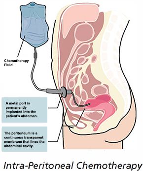 Peritoneal Metastases (Peritoneal Cancer)
