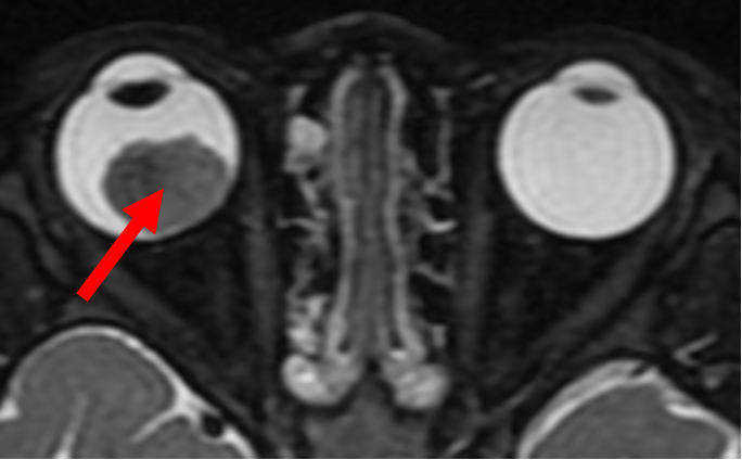 MRI scan of retinoblastoma