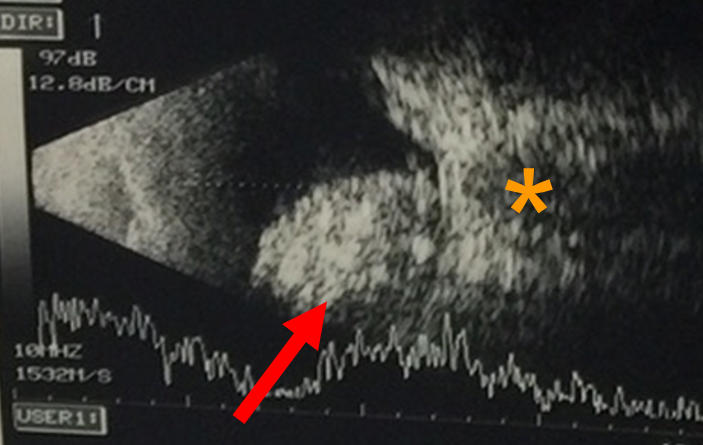This is an ultrasound scan that demonstrates the tumour (arrow), which is in close proximity to the optic nerve.