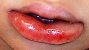 Angiodema Lips