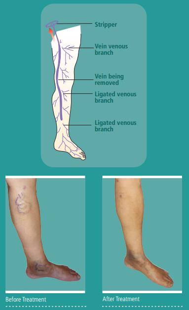 Treatment options for varicose veins