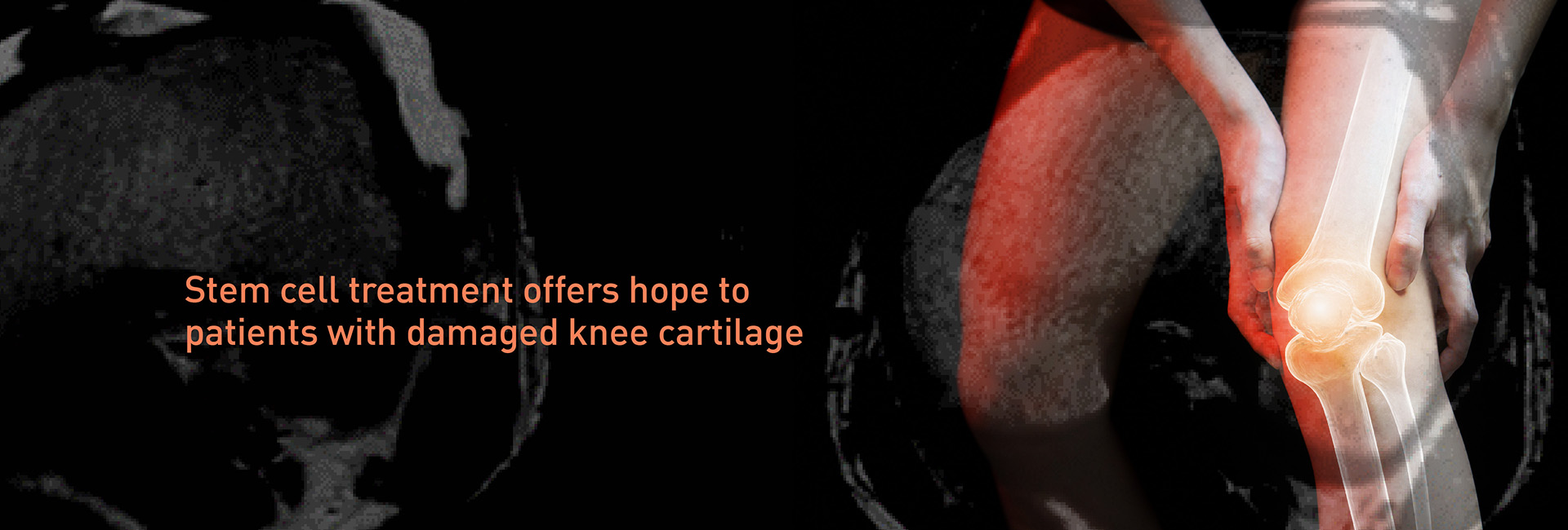 Stem cell treatment for damaged knee cartilage