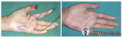 Finger Tip Injuries