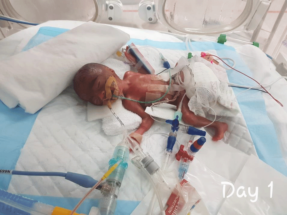Low birth weight
