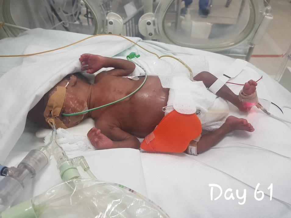 Low birth weight