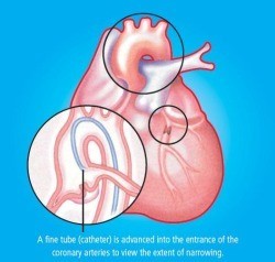 Coronary arteries