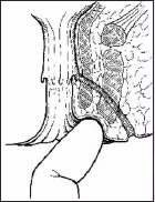 Anal Fistula