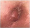 Anal Abscess Fig. 1