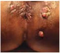 Anal Abscess Fig. 2