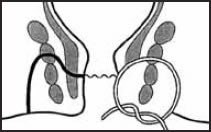 Seton Insertion