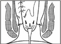 Anorectal Advancement Flap