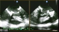 echocardiogram