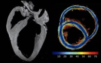 MRI