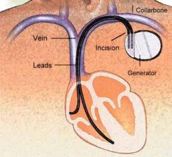 procedure