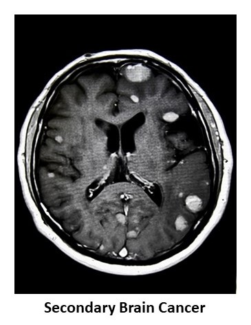 Secondary Brain Cancer