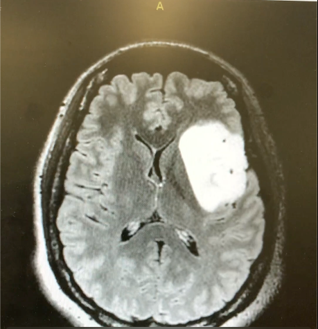 MRI of the brain