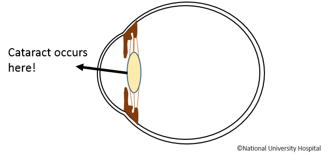 Cataract
