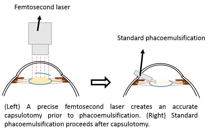 Standard phacoemulsification