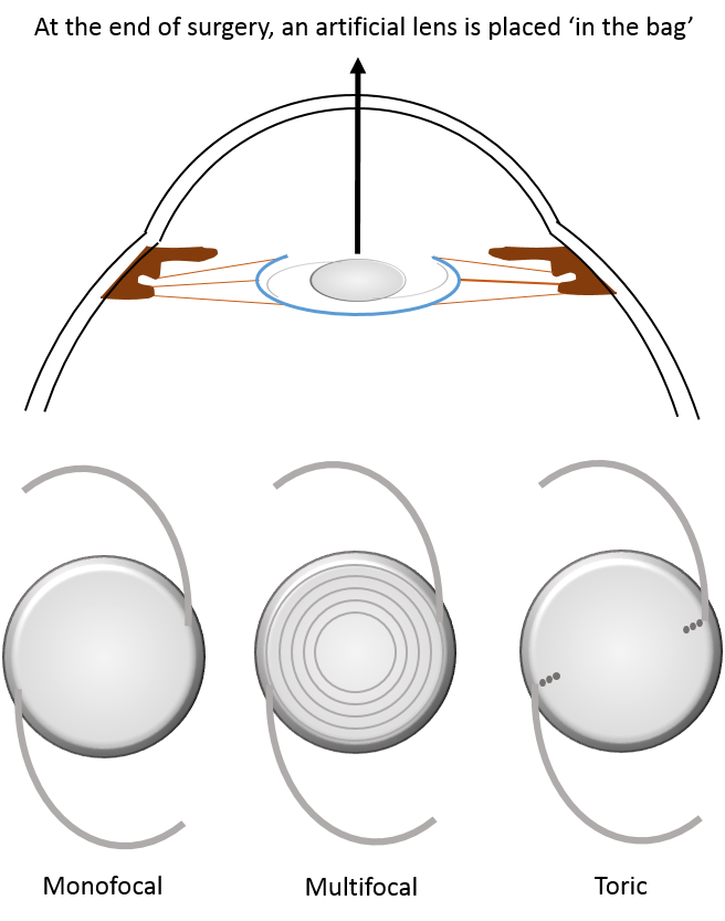 Intraocular Lenses (IOL) Types