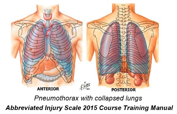 Pneumothorax