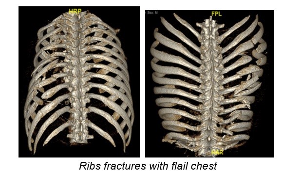 Rib fractures