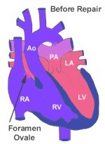 Arterial Switch Operation - Before Repair