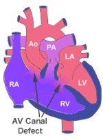 Atrio-Ventricular Septal Defect