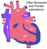 Norwood Stage I Surgery