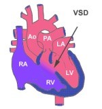 Ventricular Septal Defect