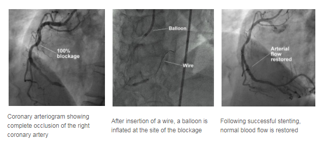 Coronary Arteriogram