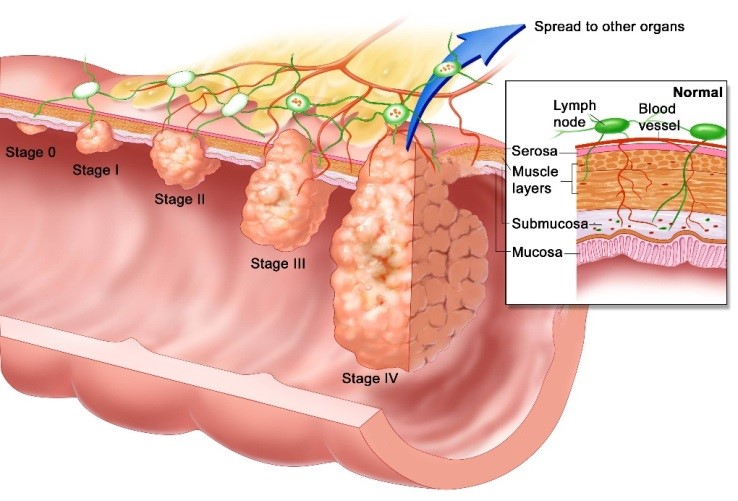 Biopsy