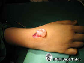 Ganglion Cysts