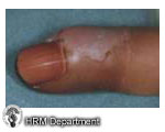 Paronychia