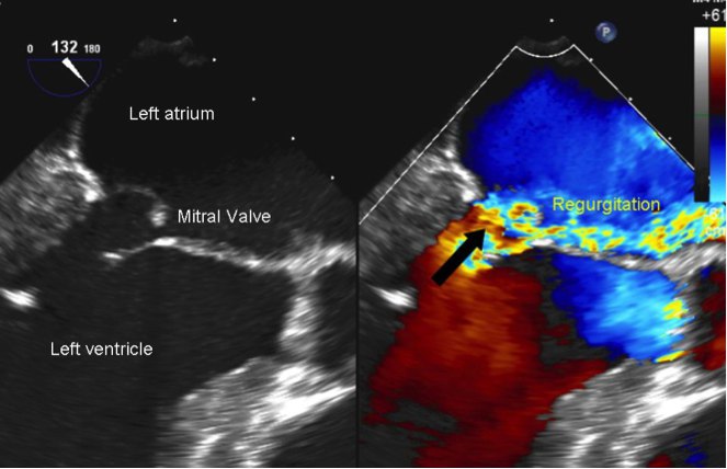 Mitral Valve Regurgitation
