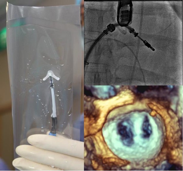 Mitraclip therapy procedure