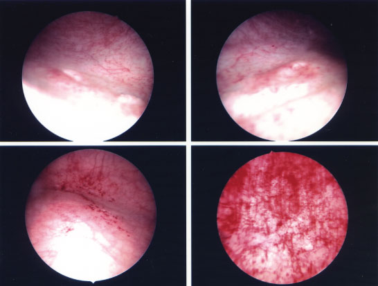 Microscopic Haematuria