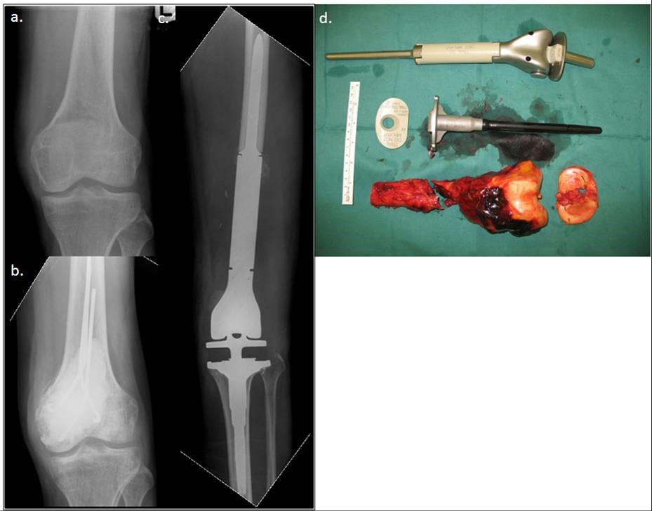 Prosthetic approaches