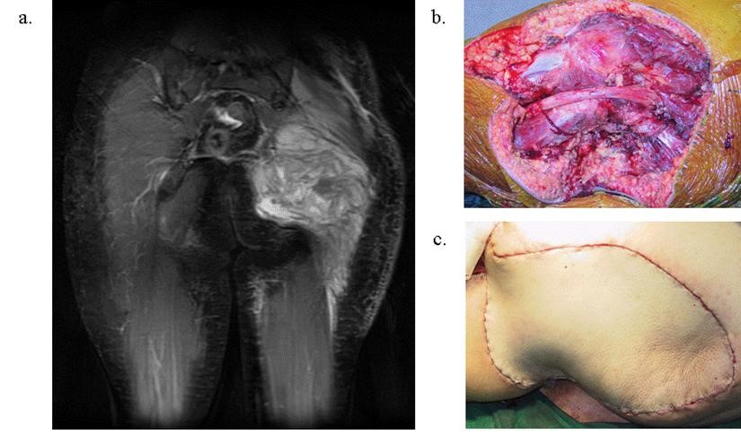 Resections