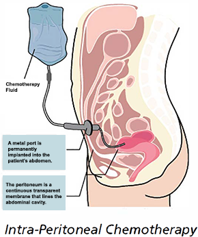 IP Chemotherapy