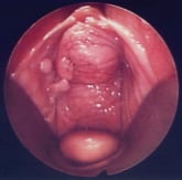 Pelvic Organ Prolapse