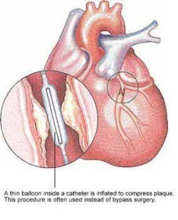 PTCA