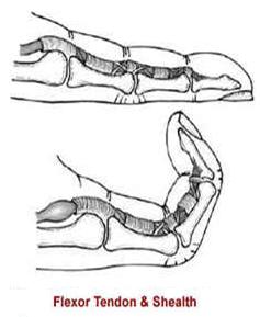 Flexor Tendon