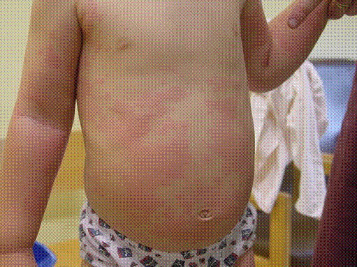 Urticaria on child