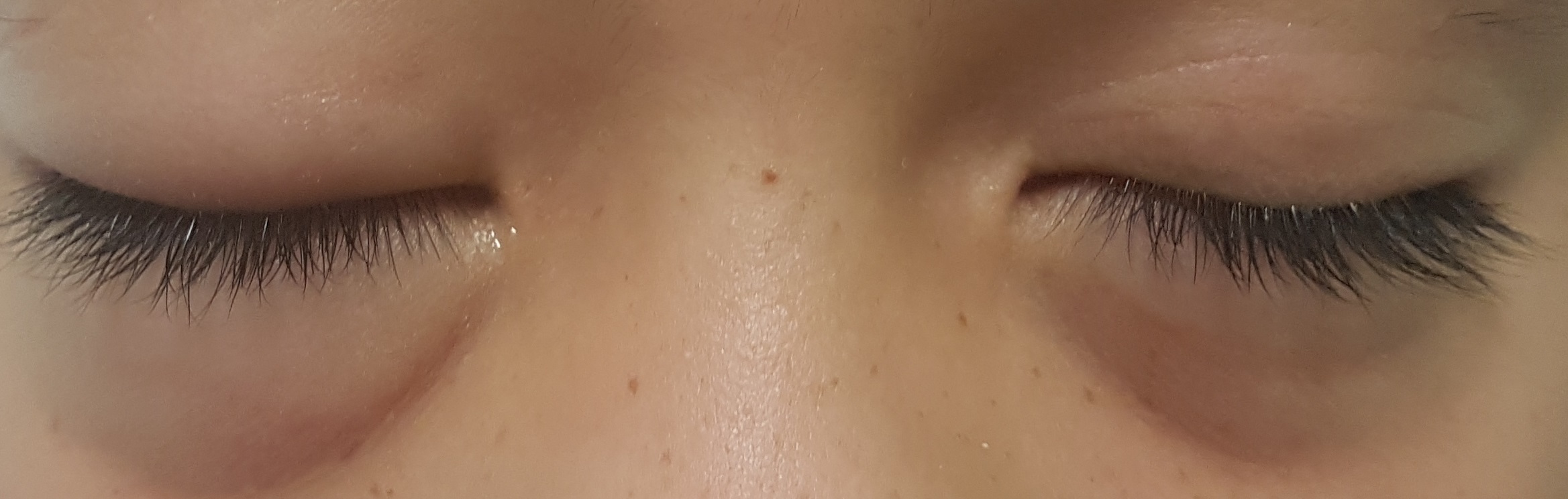 Angioedema - Eyes