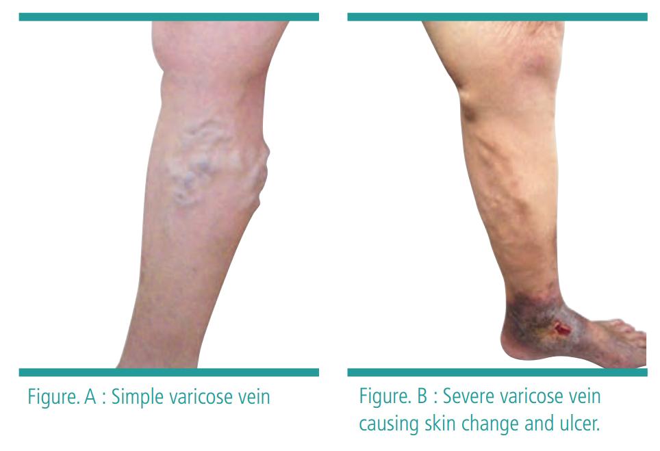Varicose Veins